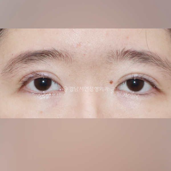 두줄따기 라인 낮추기 + 점막들림 개선 BEFORE