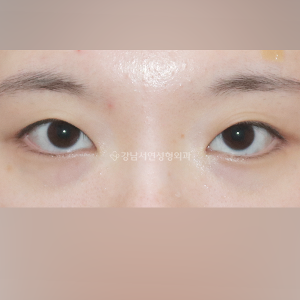 매몰쌍꺼풀 BEFORE