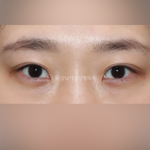 두줄따기 라인낮추기 AFTER