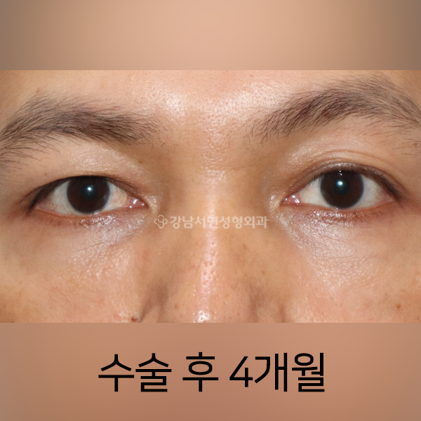 눈밑지방재배치 AFTER