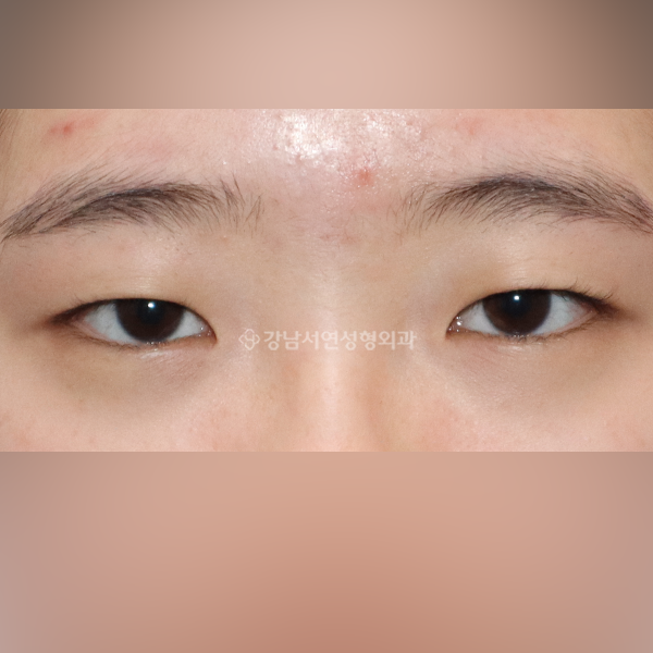 상안검 BEFORE