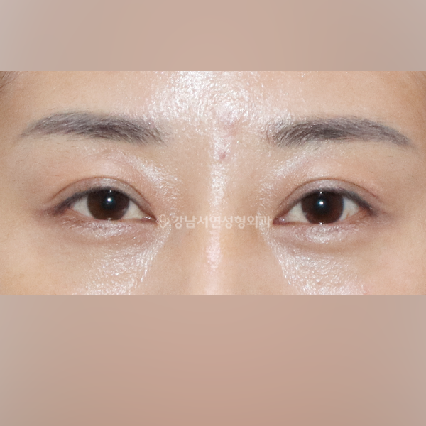 상안검 AFTER