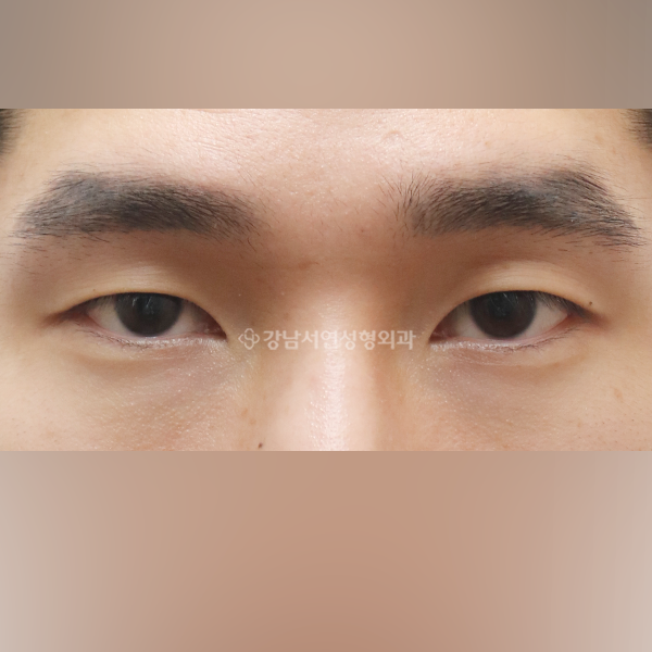 절개눈매교정 BEFORE