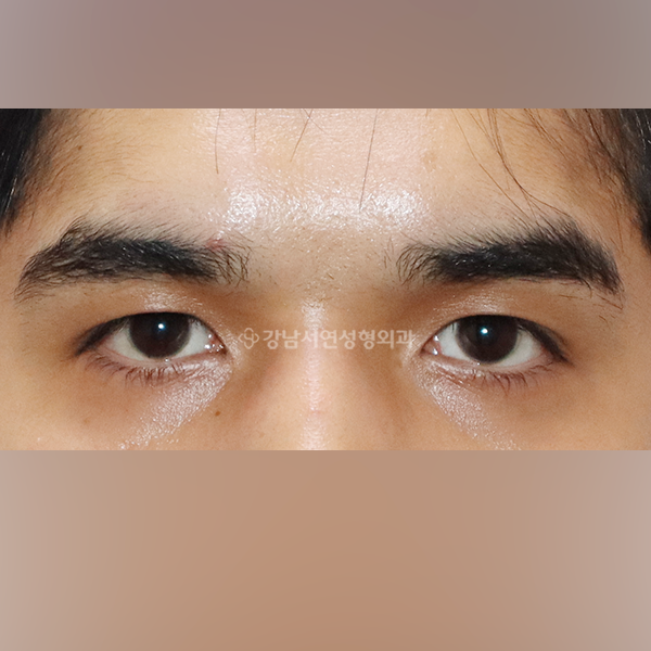 쌍꺼풀 라인 감추기 AFTER