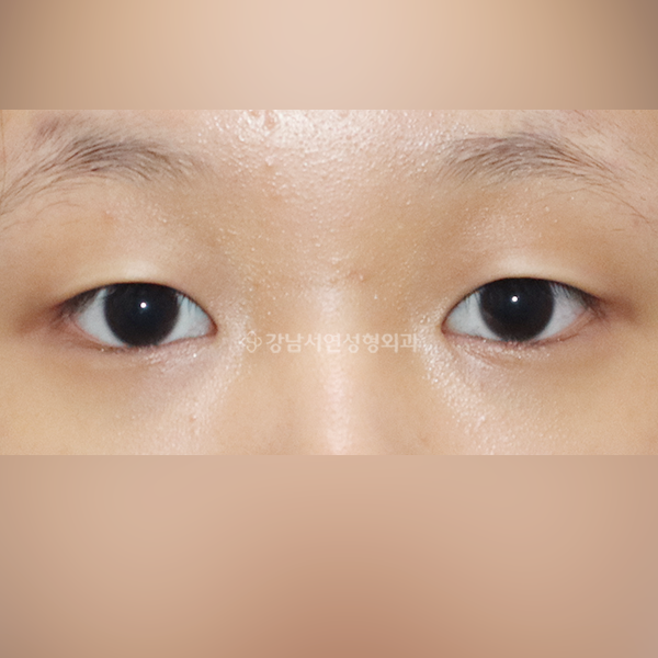 상안검 + 앞트임 BEFORE