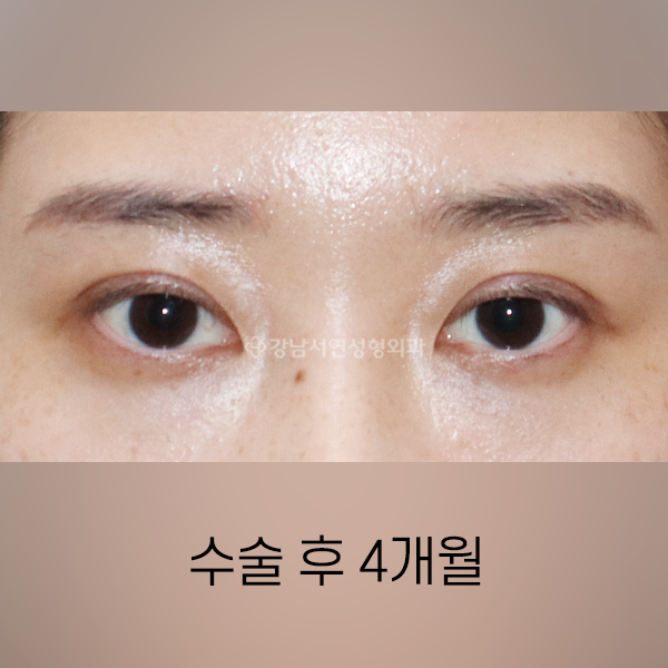 절개눈매교정 + 쌍꺼풀 겹주름 개선 AFTER