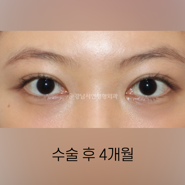 매몰쌍꺼풀 + 앞트임 AFTER