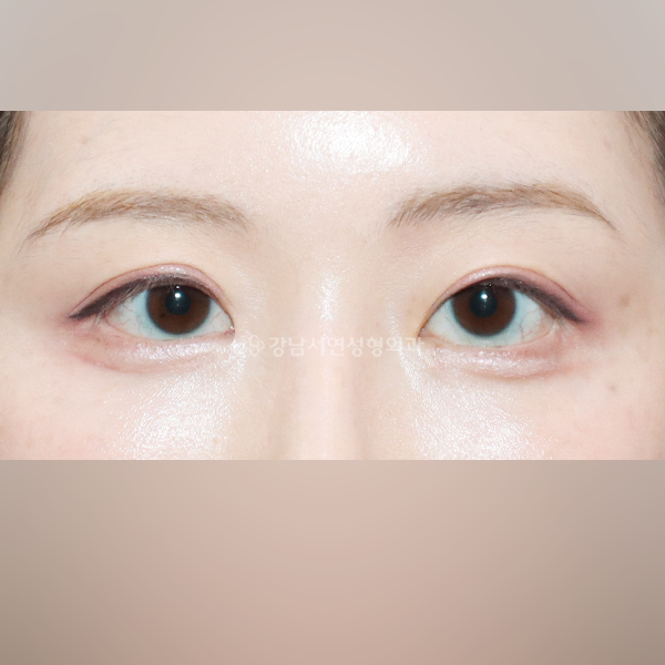 퇴축수술 AFTER