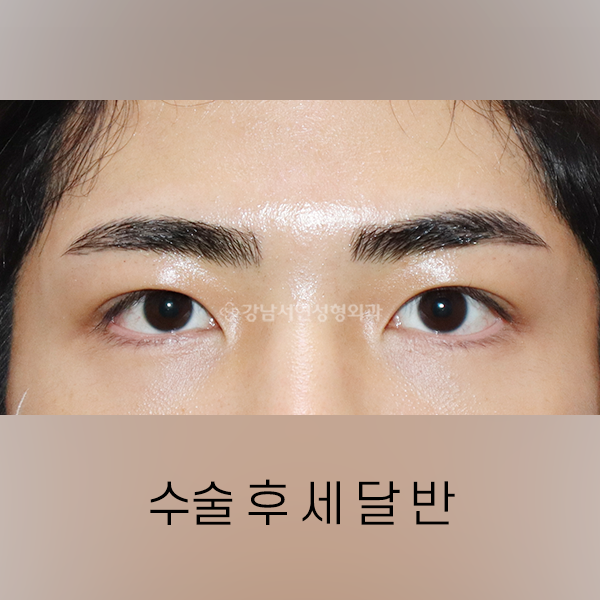 남자 눈매교정 AFTER