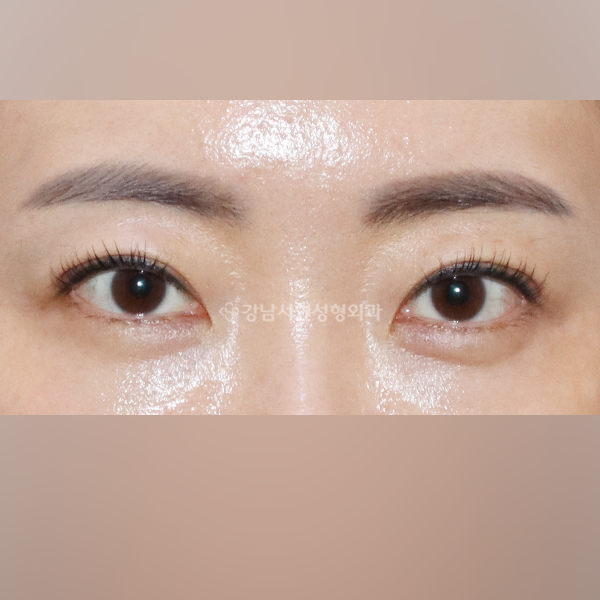 상안검 AFTER