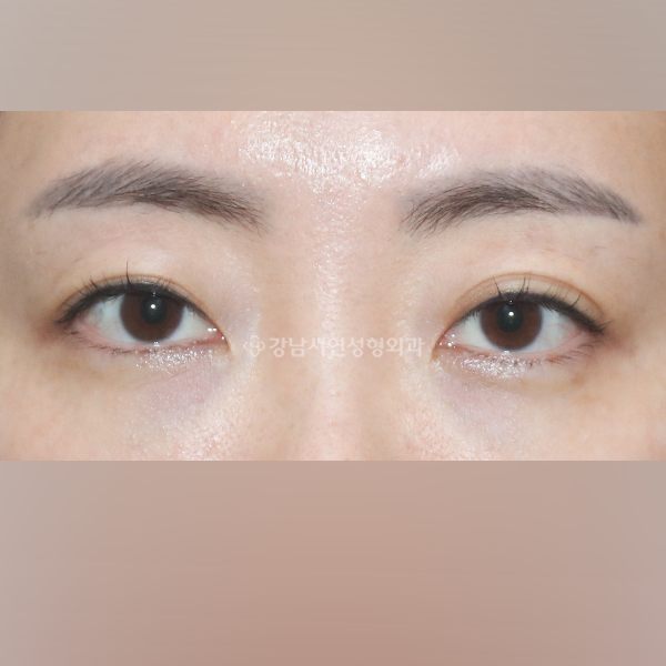 상안검 BEFORE