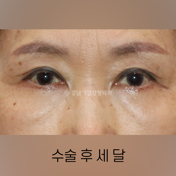 상안검 + 하안검 AFTER