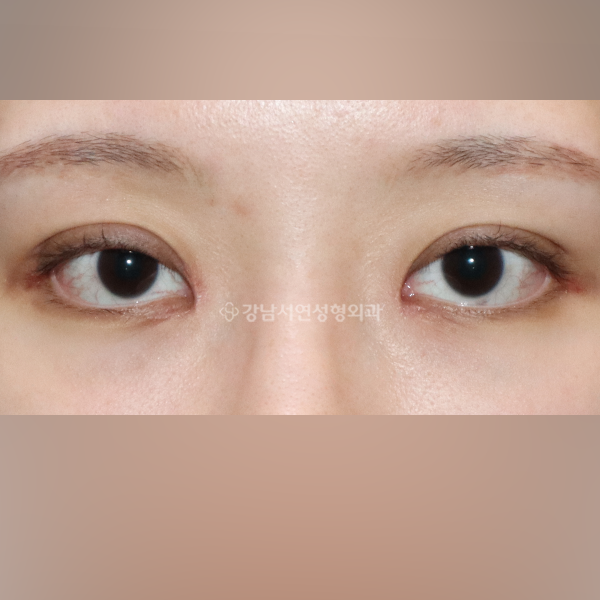 매몰법 실제거후 재수술 BEFORE