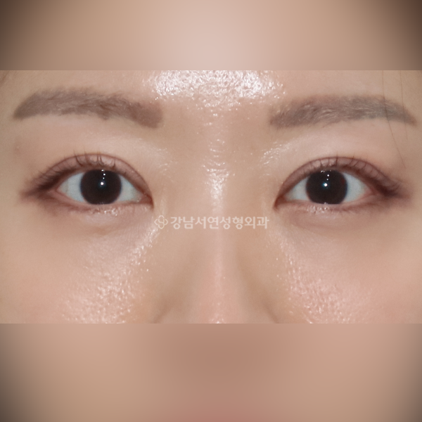 두줄따기 + 눈밑지방재배치 AFTER
