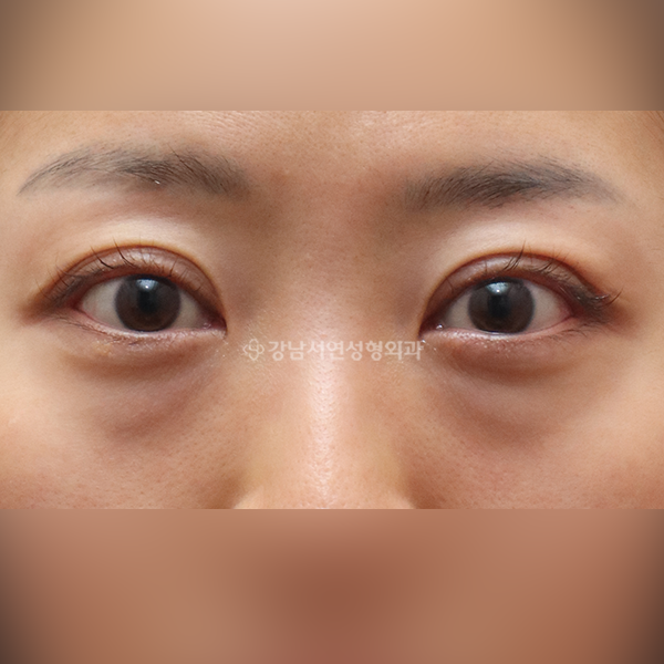 두줄따기 + 눈밑지방재배치 BEFORE
