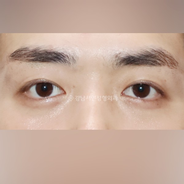 쌍꺼풀 라인낮추기 AFTER