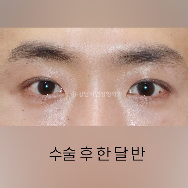 라인낮추기  +  눈매교정 AFTER