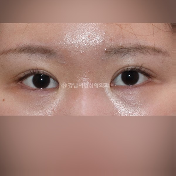 두줄따기 비대칭 맞추기 AFTER
