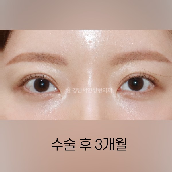 두줄따기 라인낮추기 AFTER