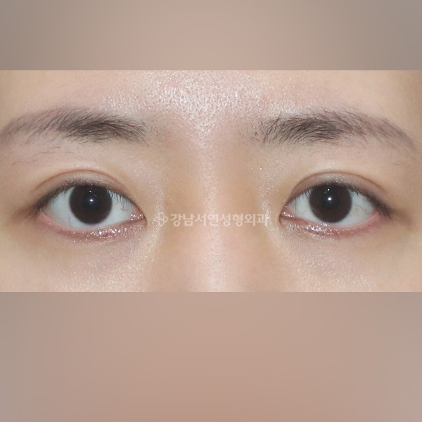 두줄따기 BEFORE