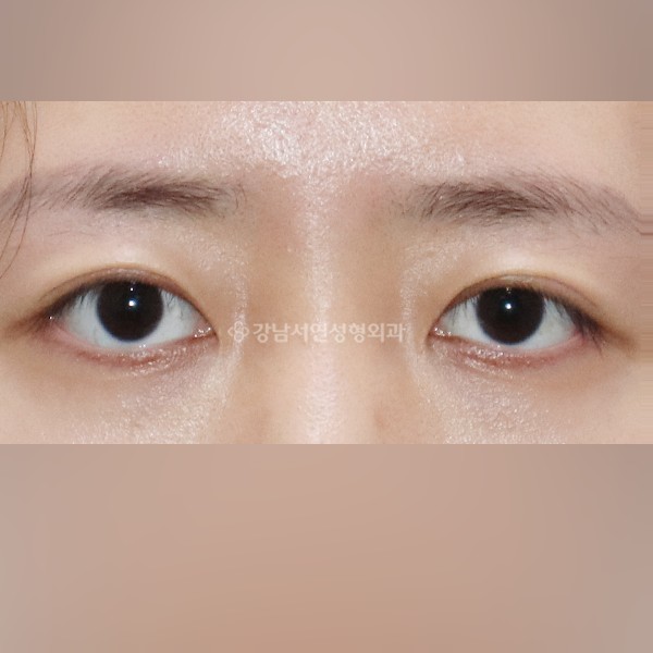 두줄따기 AFTER