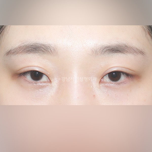 두줄따기 라인낮추기 BEFORE