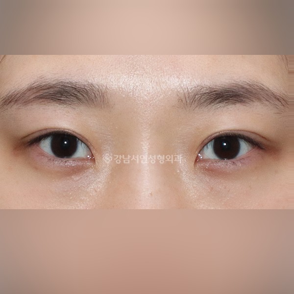 두줄따기 라인낮추기 AFTER