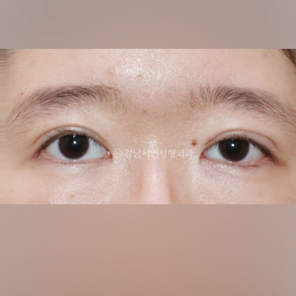 두줄따기 라인낮추기  +  점막들림 개선 AFTER