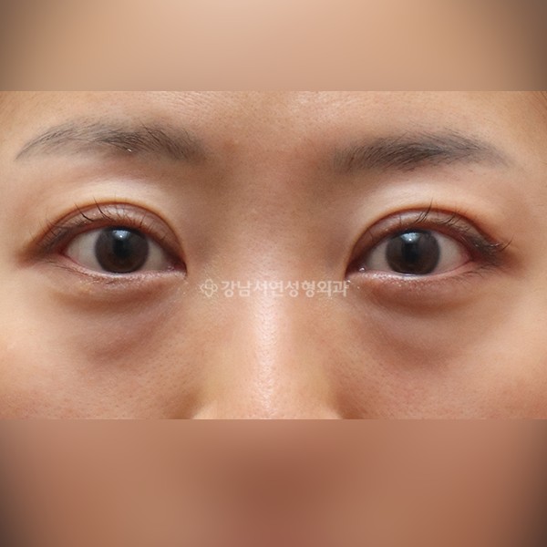 두줄따기  +  눈밑지방재배치 BEFORE