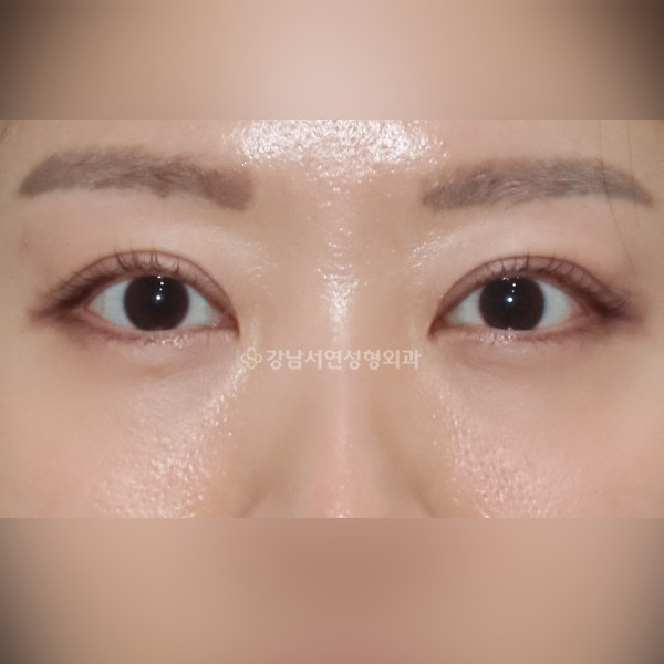 두줄따기  +  눈밑지방재배치 AFTER
