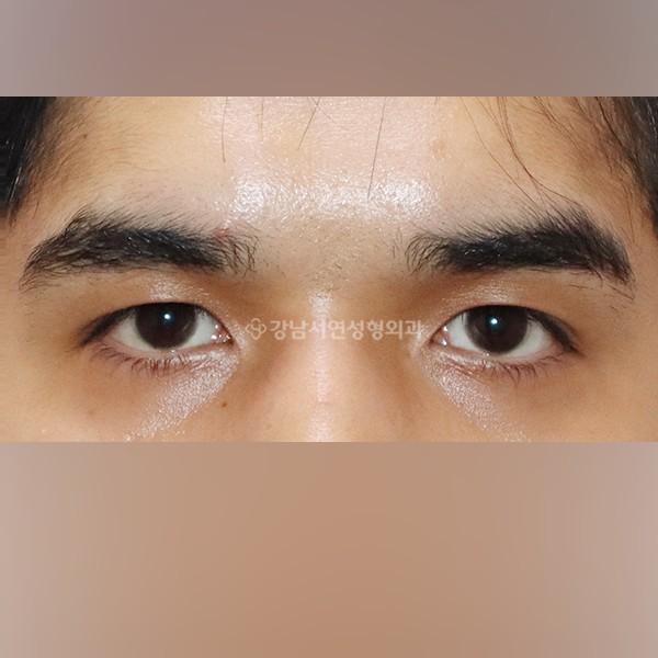 쌍꺼풀 라인 감추기 AFTER