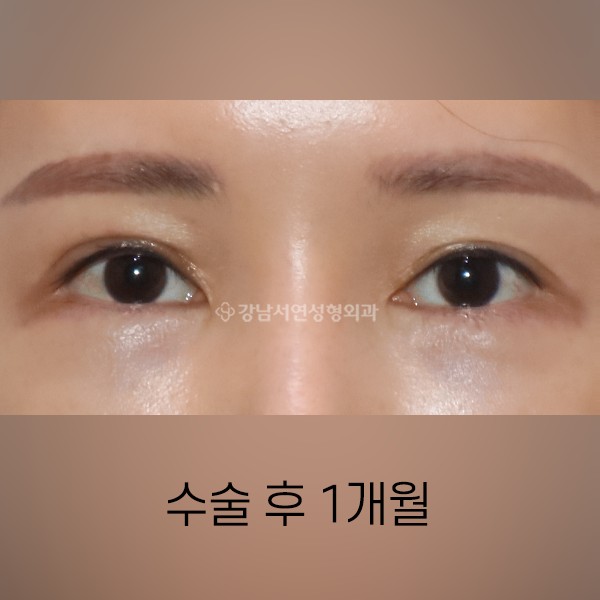 퇴축수술 AFTER