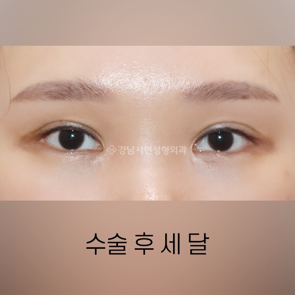 퇴축수술  +  라인정리 AFTER