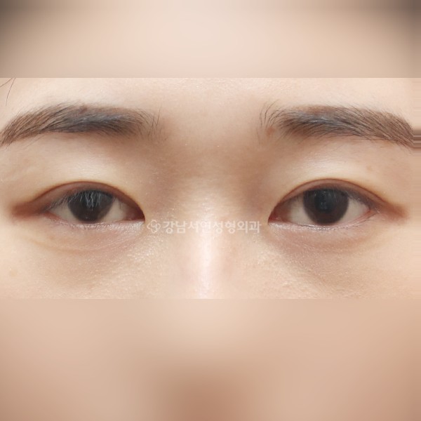 조기교정으로 공통근막(CFS) 수술 AFTER