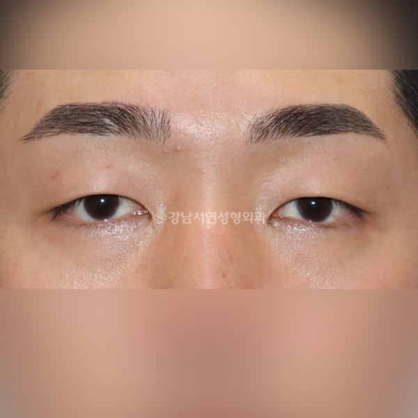 남자 가성안검하수 BEFORE