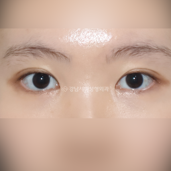 상안검 + 앞트임 AFTER