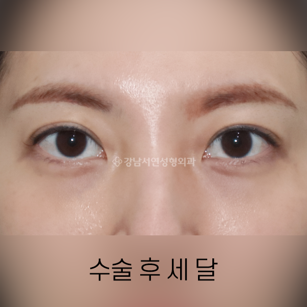 눈밑지방재배치 + 지방이식 AFTER