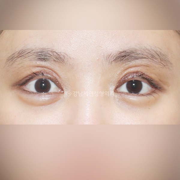 조기교정 BEFORE