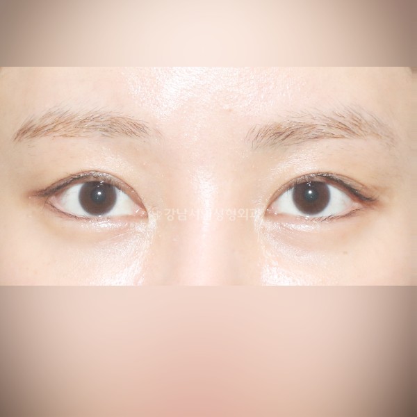 조기교정 AFTER