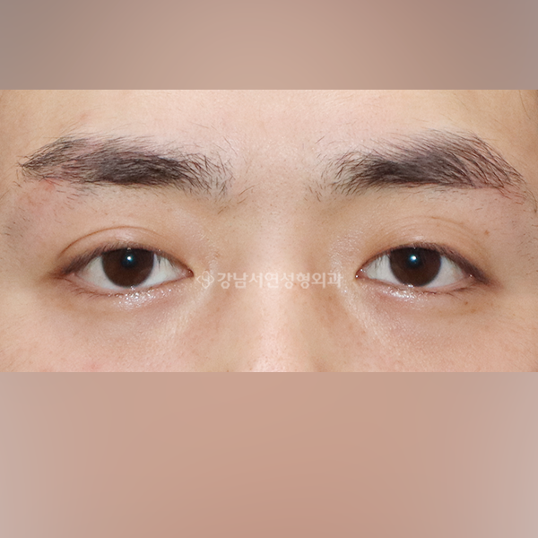 쌍꺼풀 라인낮추기 BEFORE