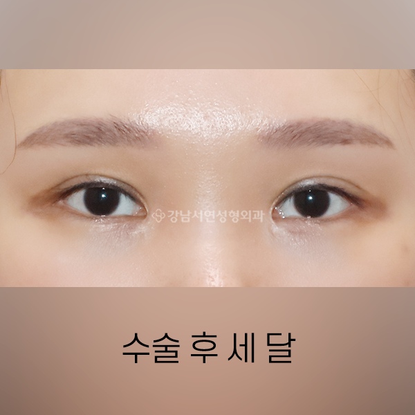 퇴축수술 + 라인정리 AFTER