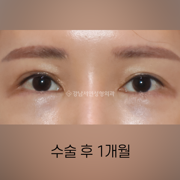 퇴축수술 AFTER