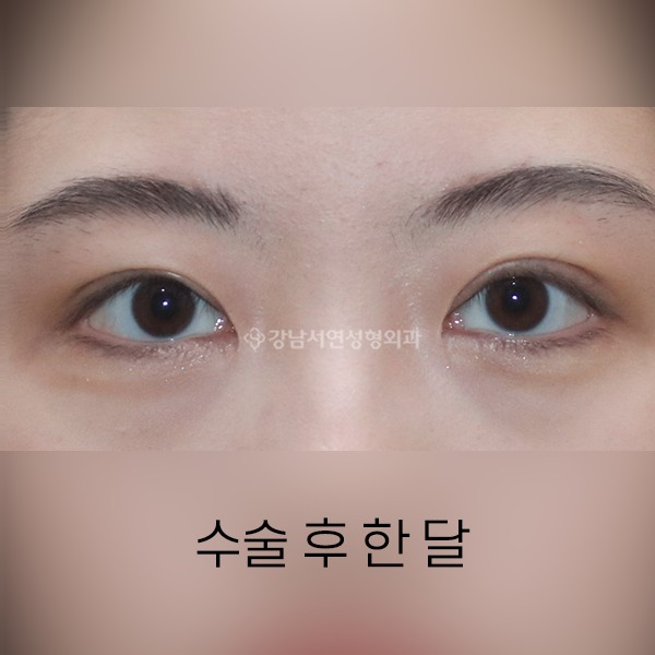 타병원 두줄따기 실패  +  2주째 조기교정 AFTER