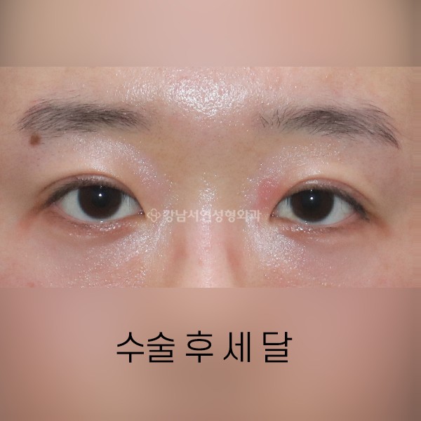 쌍꺼풀 재수술  +  점막들림, 겹주름 개선 AFTER