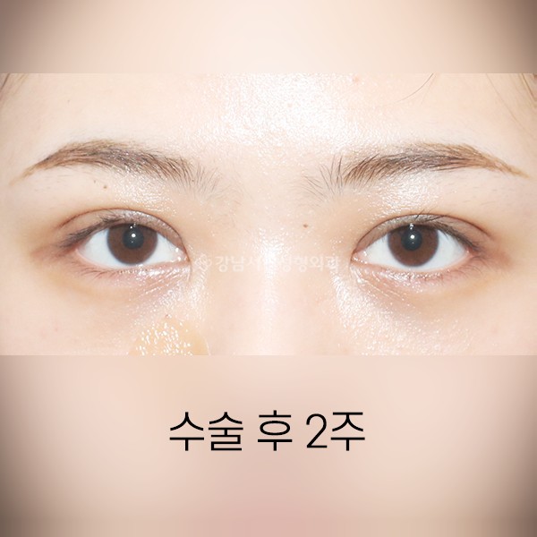 쌍꺼풀 재수술 겹주름개선 AFTER