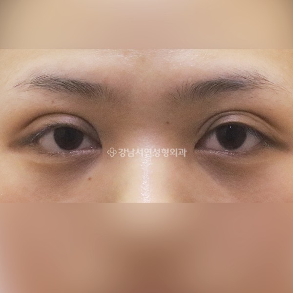쌍꺼풀 재수술 겹주름개선 BEFORE