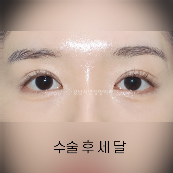 짝눈교정 AFTER