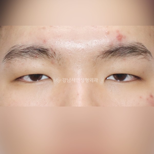 남자 쌍꺼풀 수술 BEFORE