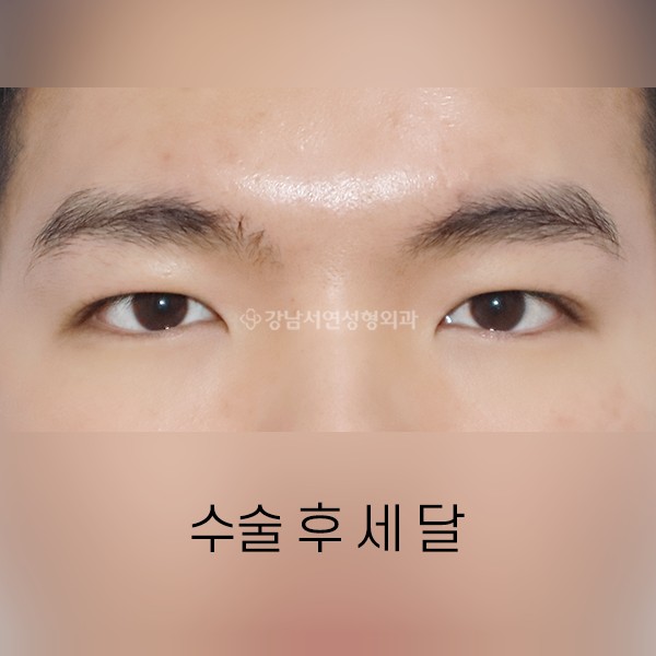 남자 쌍꺼풀 수술 AFTER