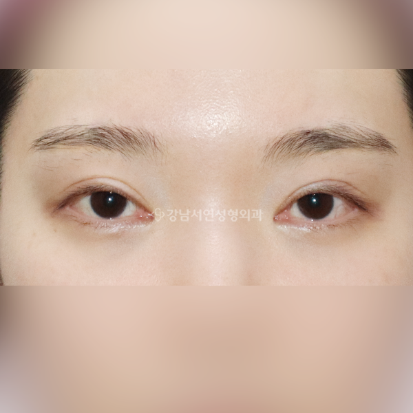 두줄따기 BEFORE